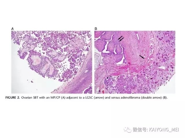 卵巢癌的病理诊断新进展（一）