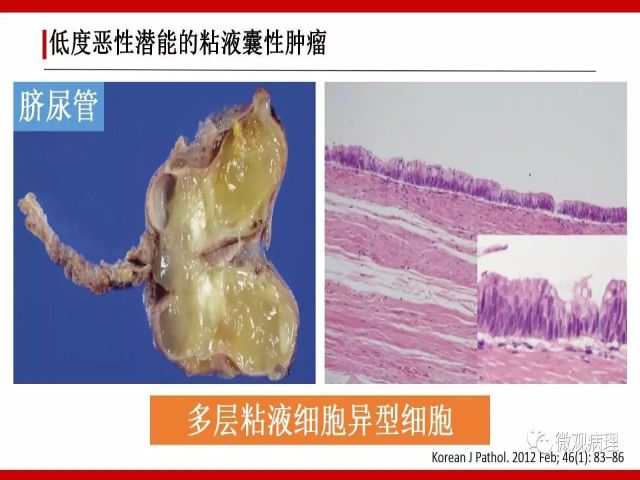 泌尿课程/尿路腺样病变的诊断要点