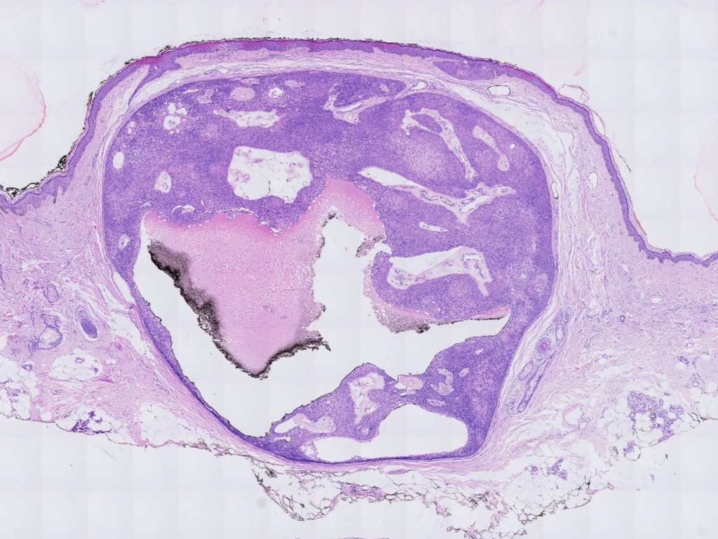 汗腺瘤