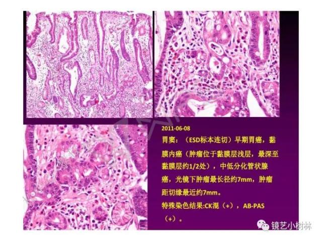 上消化道早癌病理的学习心得体会（附胃牵手癌的病例特点文献学习）