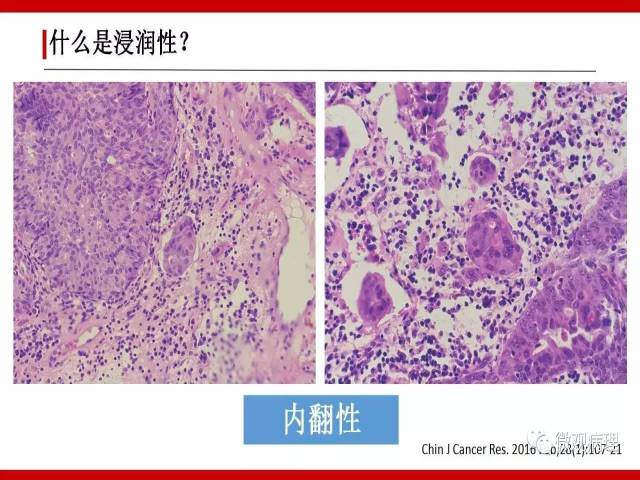 泌尿课程/浸润性尿路上皮癌病理学类型