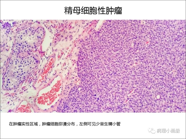 泌尿病理--精原细胞瘤VS精母细胞瘤