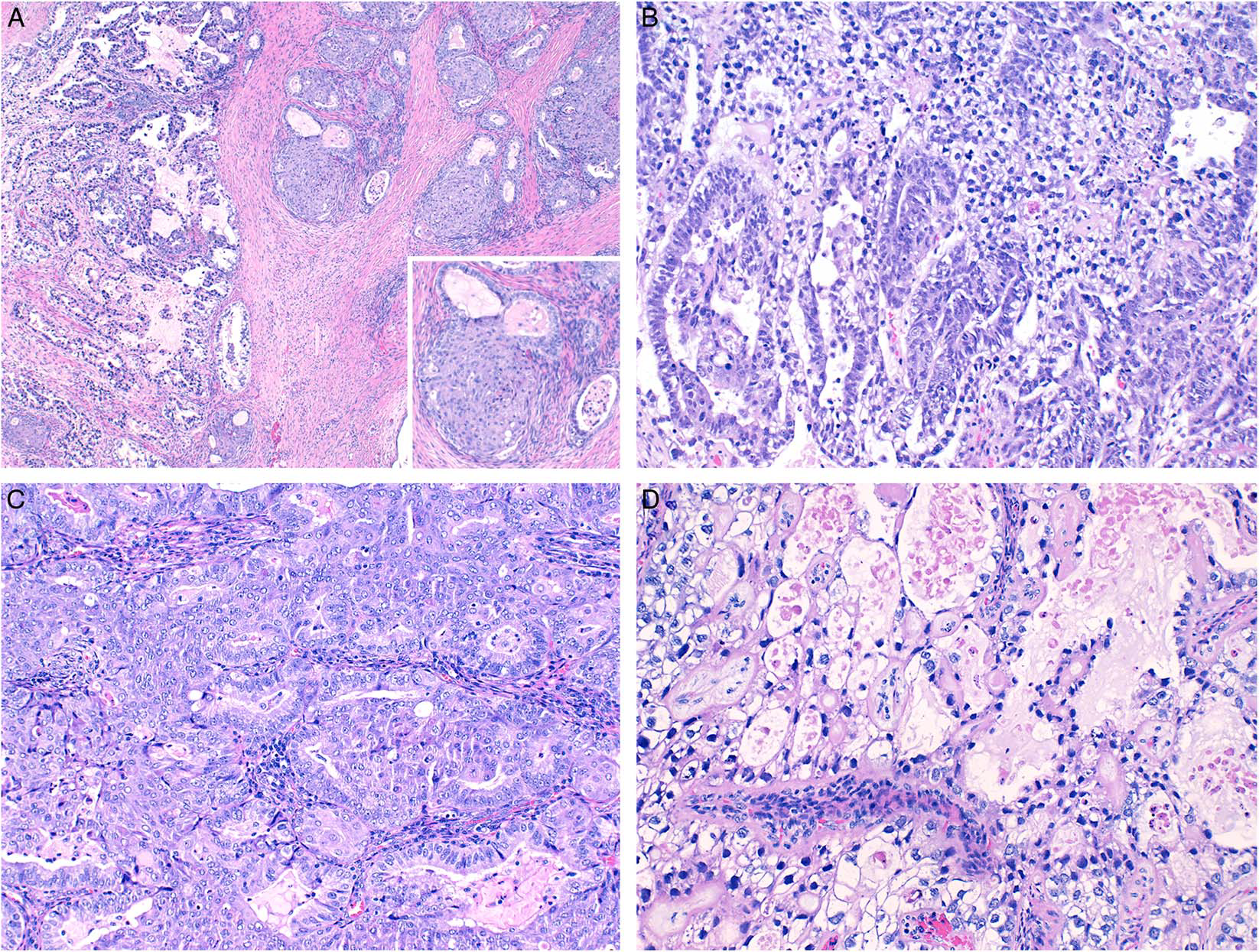 读文献，学病理-40岁以上女性恶性肿瘤中的卵黄囊瘤分化
