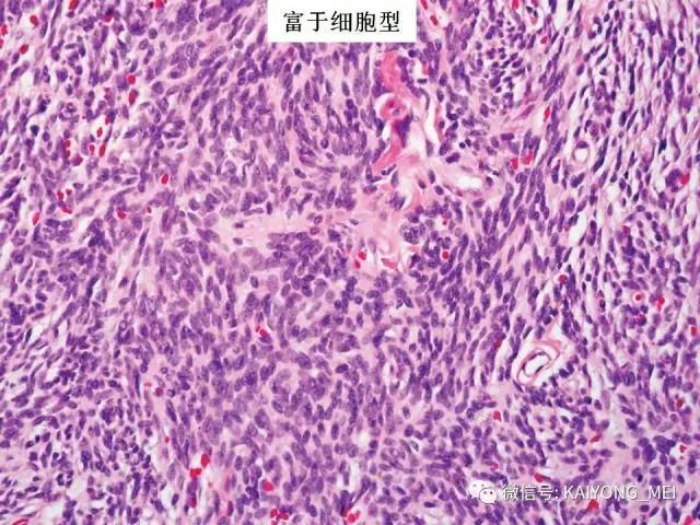 乳腺梭形细胞病变的病理诊断及进展（一）