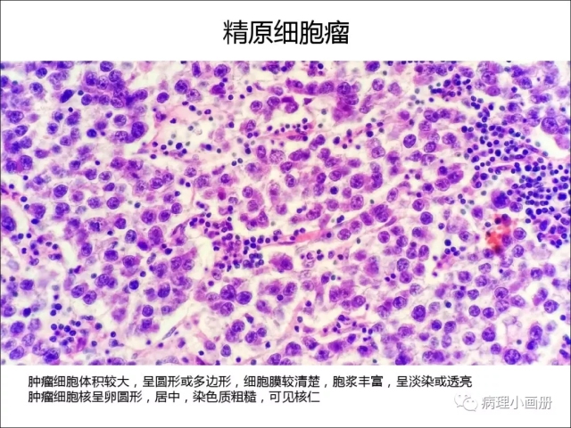 泌尿病理--精原细胞瘤VS精母细胞瘤