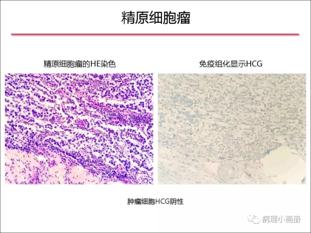 泌尿病理--精原细胞瘤VS精母细胞瘤