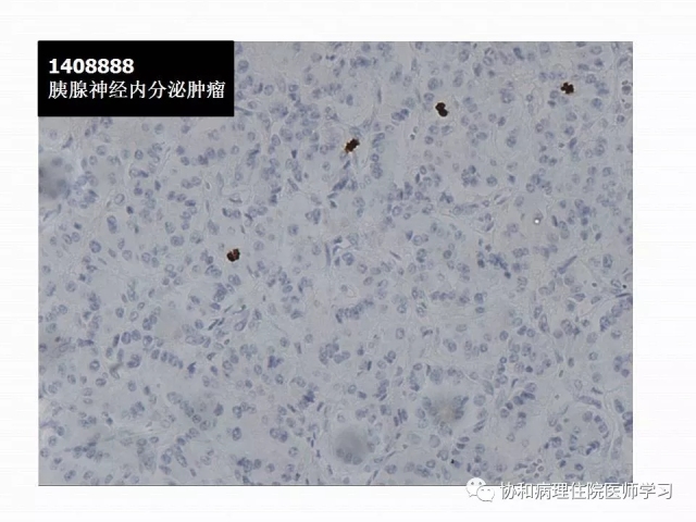 病理学基础知识 : 核分裂像的识别