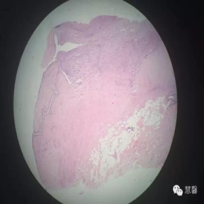 High grade nested variant Urothelial carcinoma(老胡分享，孔祥田老师讲解)