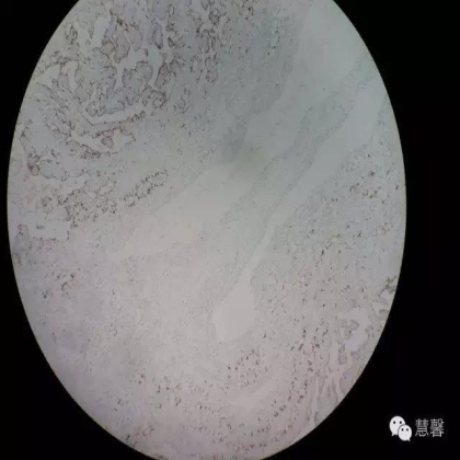 透明细胞乳头状肾细胞癌？TFE3 Traslocation Carcinoma？（赵洋分享，孔祥田(Max)*NM老师讲解）