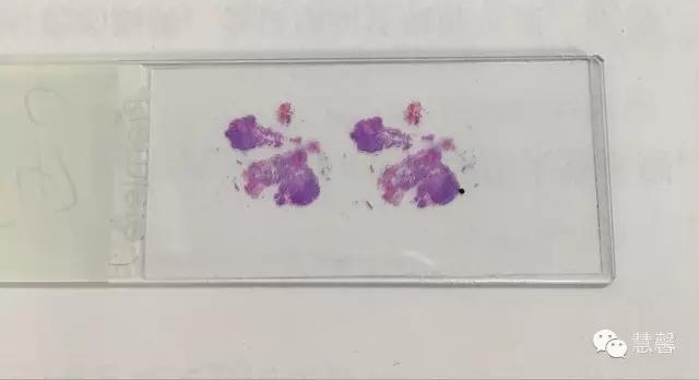 增殖性膀胱炎背景上的内翻性乳头状瘤（孔祥田(Max)*Roswell*NM]讲解）
