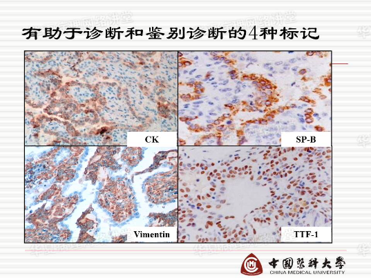 结合实际病例学习《硬化性肺细胞瘤的诊断陷阱》