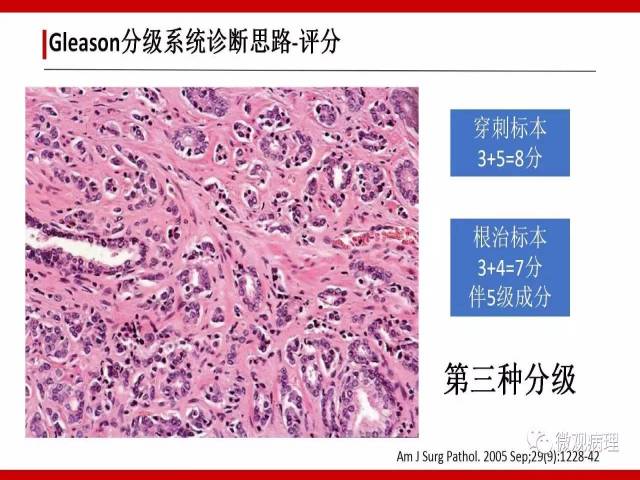 前列腺癌Gleason分级系统的前世今生