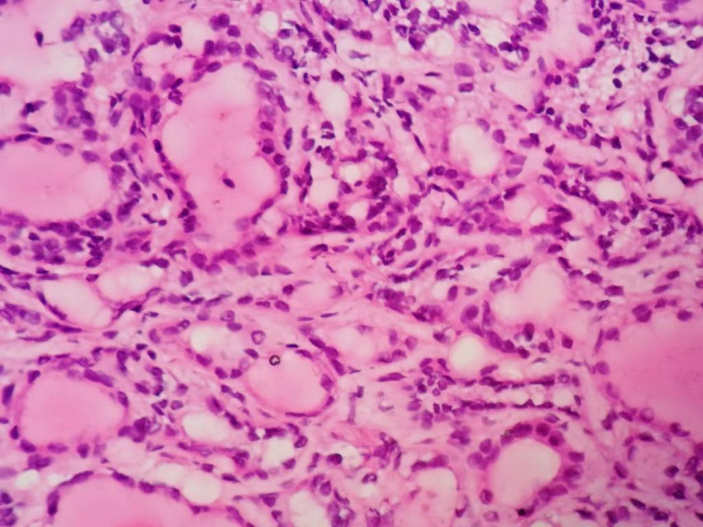 不典型的甲状腺乳头状癌？（札记八十）