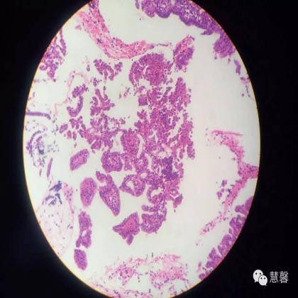 子宫内膜乳头状增生（甜甜分享病例，孔祥田(Max)*Roswell*老师讲解，kent翻译整理文献）