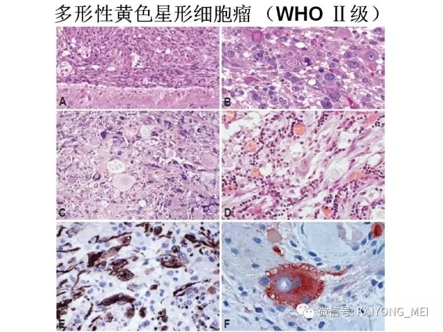 2016 WHO中枢神经系统肿瘤分类解读（二）