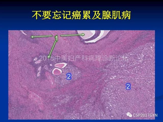 子宫内膜癌：诊断与进展
