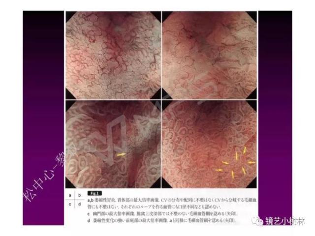 上消化道早癌病理的学习心得体会（附胃牵手癌的病例特点文献学习）
