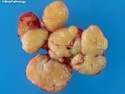 乳腺病理-乳腺良性增生-纤维腺瘤