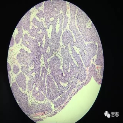 增殖性膀胱炎背景上的内翻性乳头状瘤（孔祥田(Max)*Roswell*NM]讲解）
