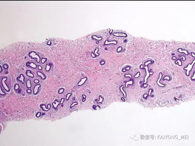 乳腺梭形细胞病变的病理诊断及进展（一）