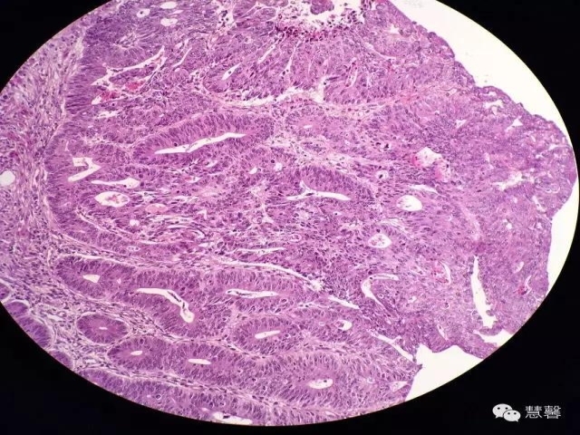 结、直肠管绒毛状腺瘤-高级别病变诊断等相关问题2（悄悄分享、孔祥田(Max)*Roswell*老师讲解）
