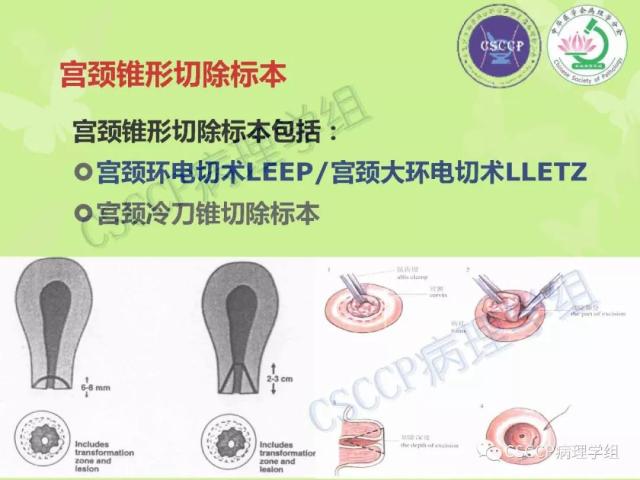 宫颈与子宫病变病理标本取材