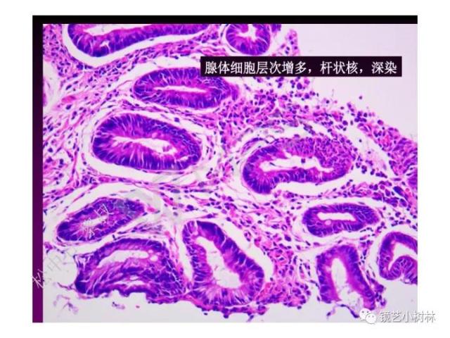 上消化道早癌病理的学习心得体会（附胃牵手癌的病例特点文献学习）