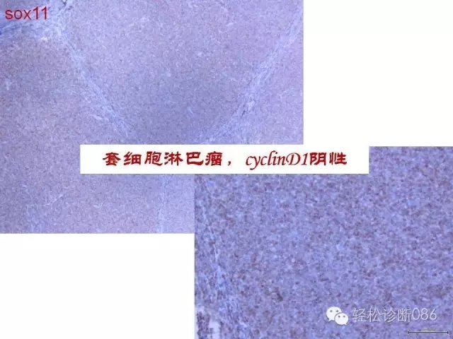 关于套细胞淋巴瘤的总结课件