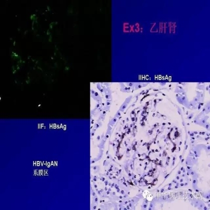 探讨免疫组织学在肾穿标本中的应用