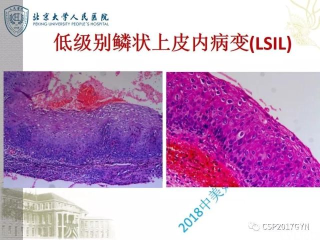 宫颈鳞状上皮内病变病理诊断中问题
