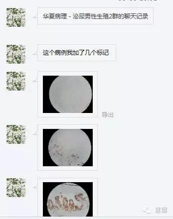 透明细胞乳头状肾细胞癌？TFE3 Traslocation Carcinoma？（赵洋分享，孔祥田(Max)*NM老师讲解）