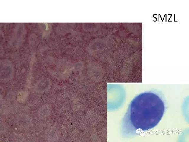 边缘区淋巴瘤（附小B细胞NHL鉴别诊断）