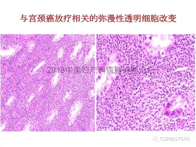 子宫内膜假肿瘤性病变及类似癌样病变