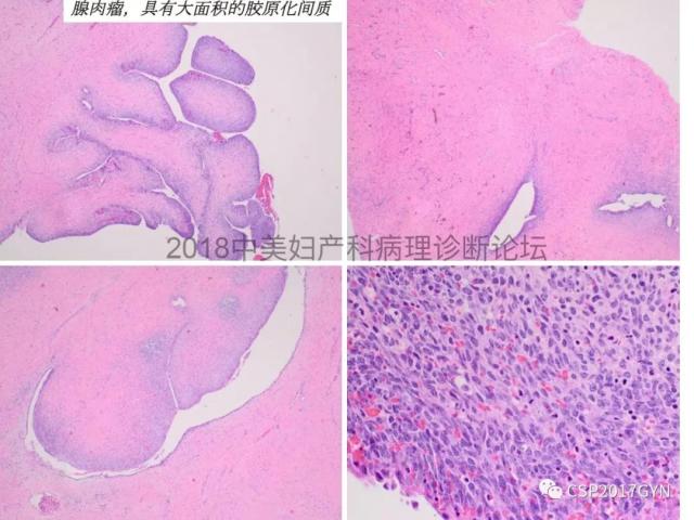 子宫内膜假肿瘤性病变及类似癌样病变