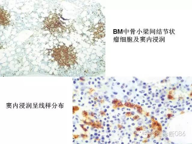 边缘区淋巴瘤（附小B细胞NHL鉴别诊断）