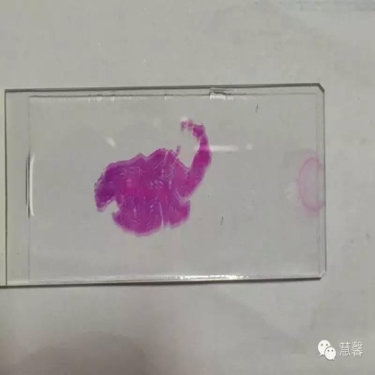 子宫腺肉瘤【吴梅娟】分享；【刘从容】老师讲解）