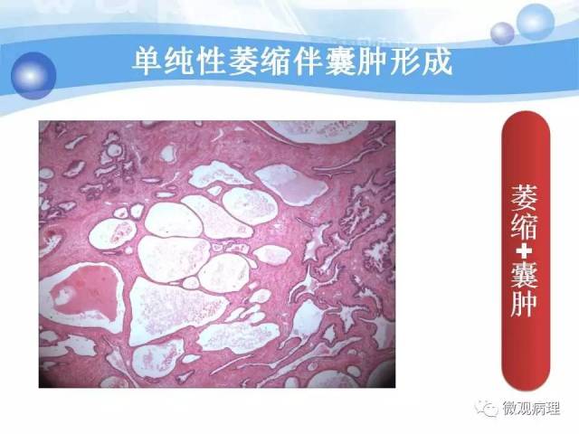 泌尿课程/局灶性前列腺萎缩
