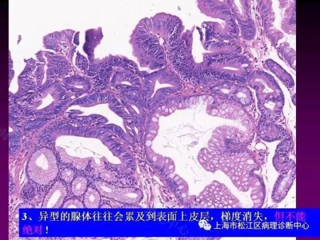 上消化道低级别上皮内瘤变的那些事