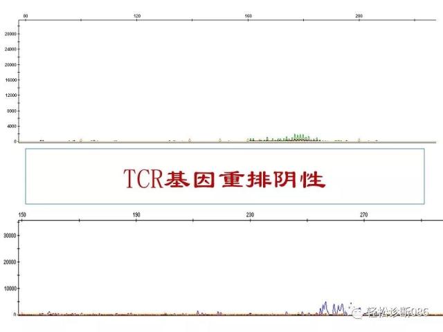 淋巴母细胞淋巴瘤
