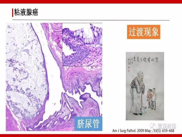 泌尿课程/尿路腺样病变的诊断要点