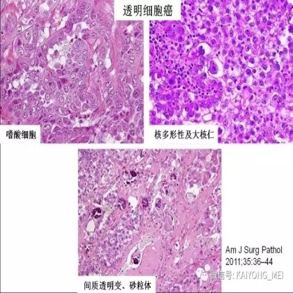 卵巢癌的病理诊断新进展（三）