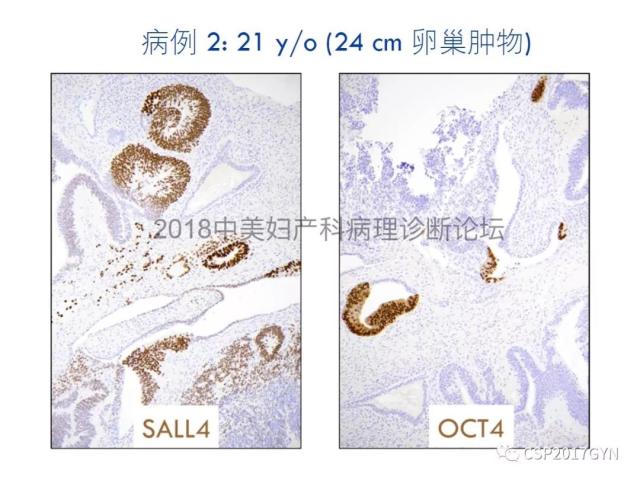 女性生殖道发育