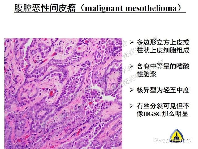 中华病理学会基层培训遵义站讲座（一）——卵巢和输卵管浆液性肿瘤的诊断和鉴别诊断