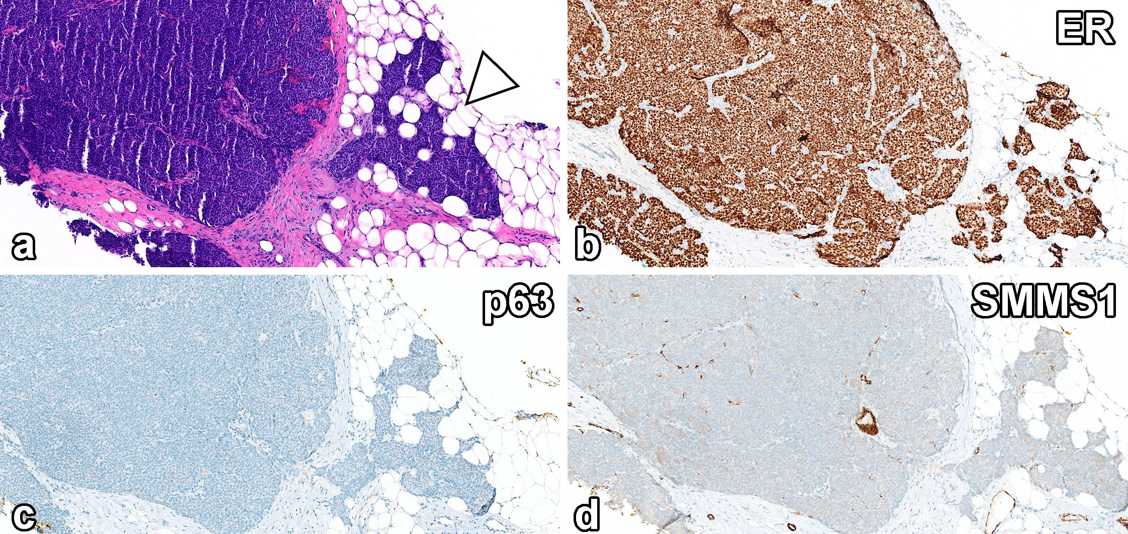 读文献，学病理-乳腺乳头状肿瘤难点总结（一）