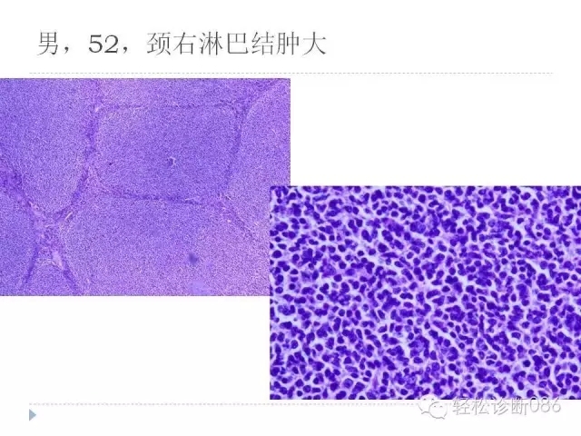 关于套细胞淋巴瘤的总结课件