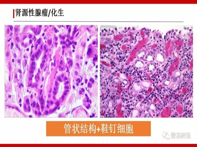 泌尿课程/尿路腺样病变的诊断要点