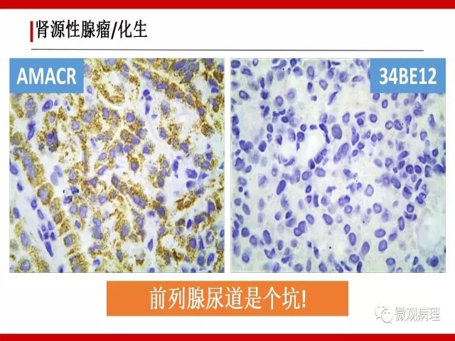 泌尿课程/尿路腺样病变的诊断要点