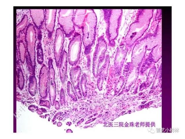 上消化道早癌病理的学习心得体会（附胃牵手癌的病例特点文献学习）