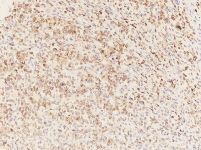 肾透明细胞肉瘤的临床病理学特征