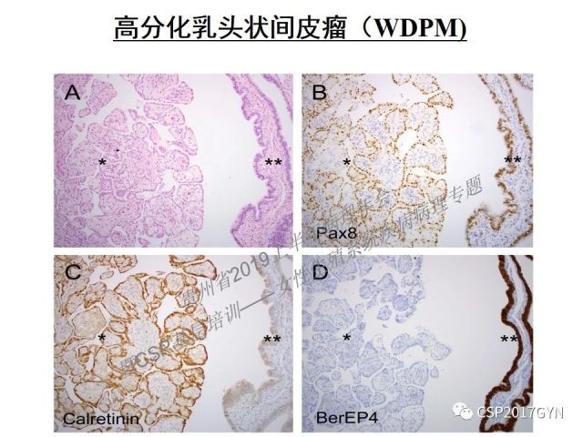 中华病理学会基层培训遵义站讲座（一）——卵巢和输卵管浆液性肿瘤的诊断和鉴别诊断